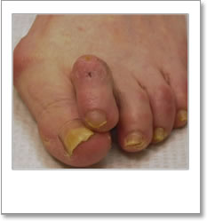 Structural abnormality - 2nd toe overlapping large toe