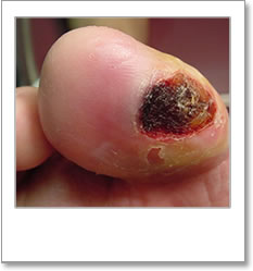 Ulceration on the large toe